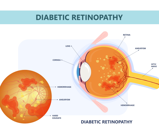 Glaucoma Illustration