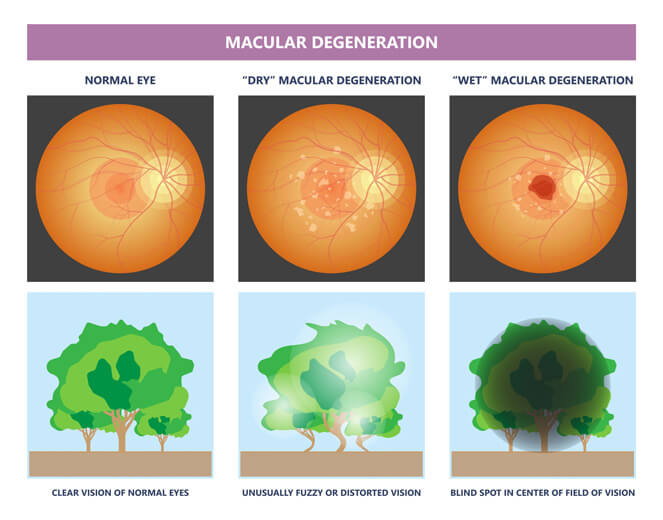 Macular degeneration illustration